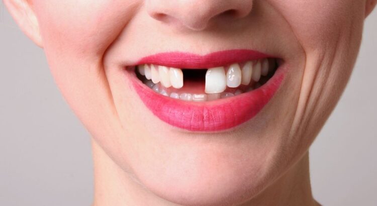 O que pode causar a queda de um dente